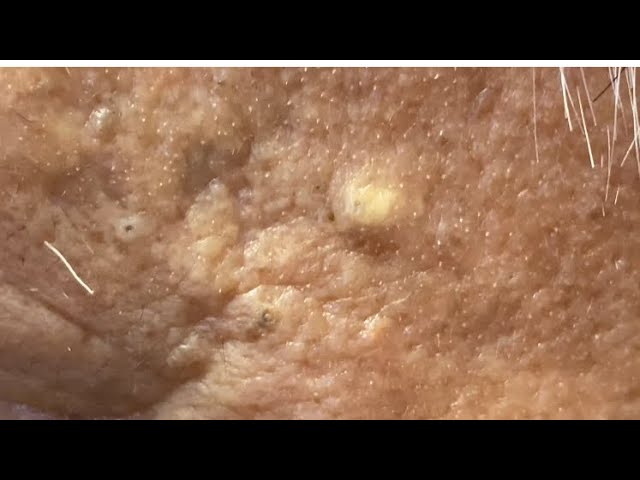 Milia And Blackheads