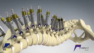 Stryker (K2M): Mesa 2 Dual Differential Correction
