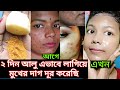 আমি কিভাবে মুখের কালো দাগ দূর করলাম? ব্রণের দাগ, কালো দাগ দূর করার ঘরোয়া উপায় | Dark spot remove