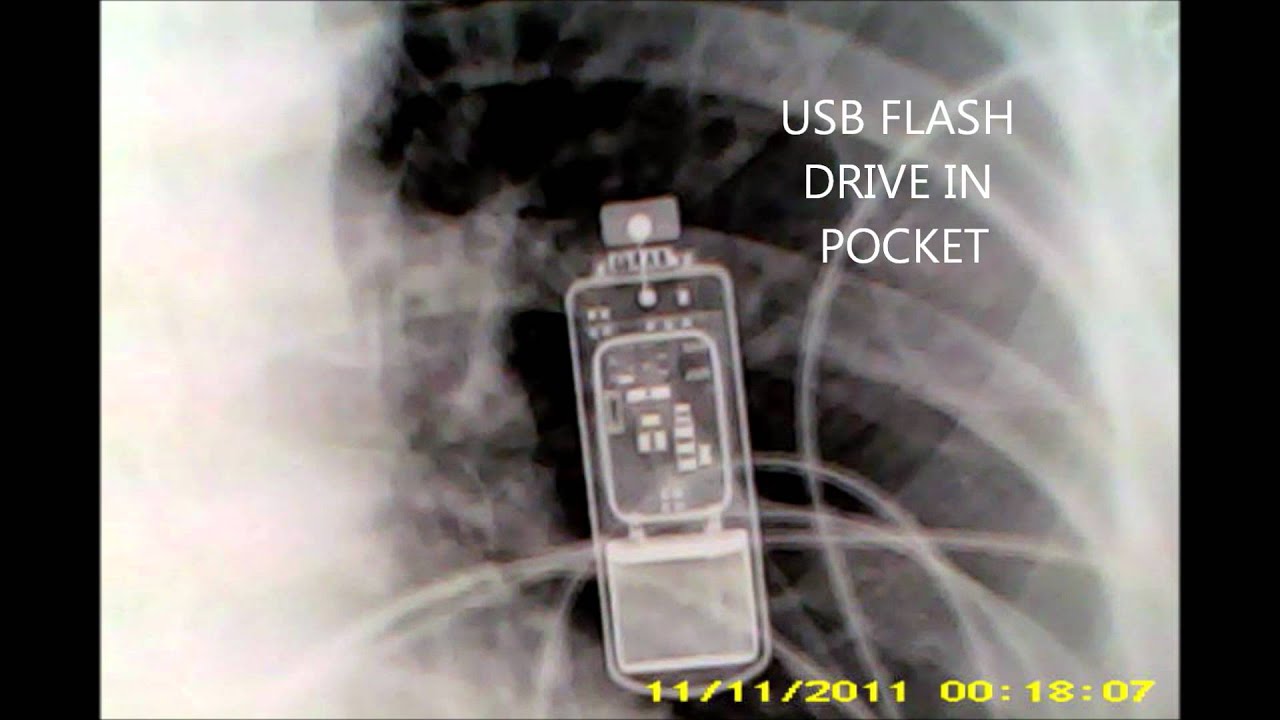 Xray of USB Flash Memory drive CXR Chest Xray Practical Review YouTube