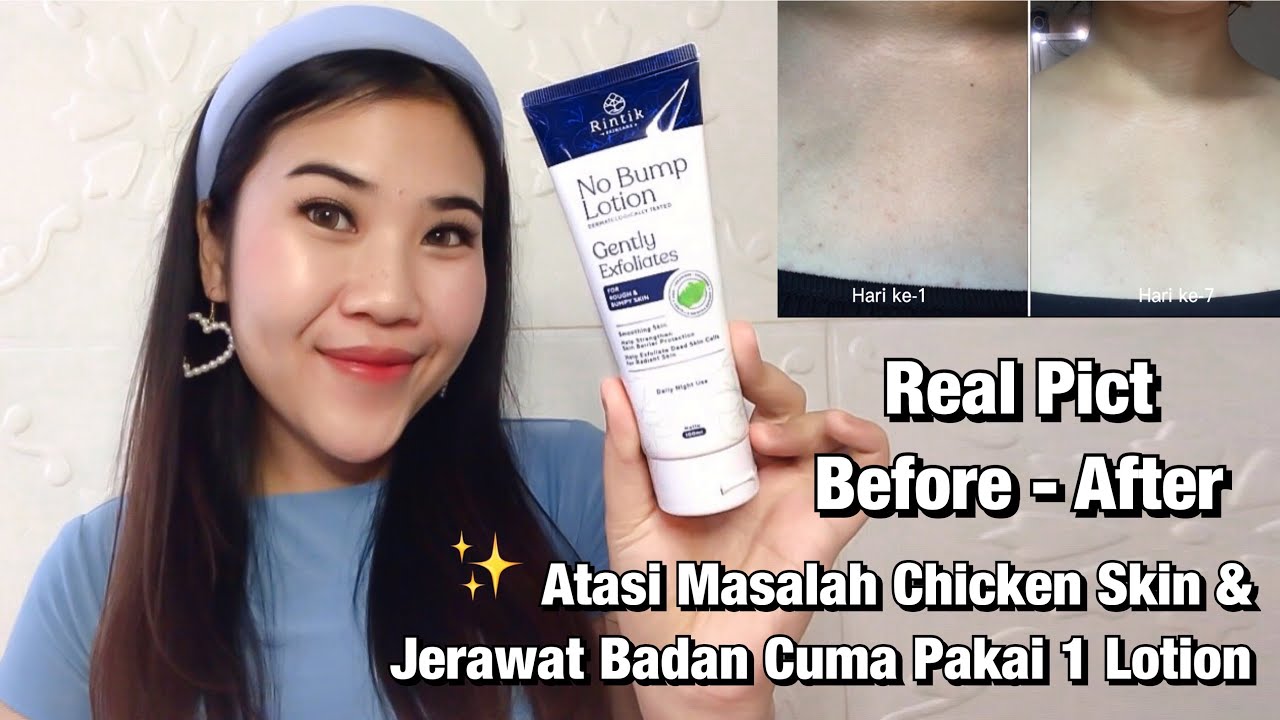 Review Jujur Lotion Ajaib Ampuh Atasi Chicken Skin & Jerawat Di Badan