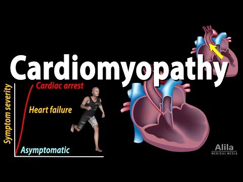 Video: Kardiomiopati Alkoholik: Gejala, Pengobatan, Penyebab, Prognosis