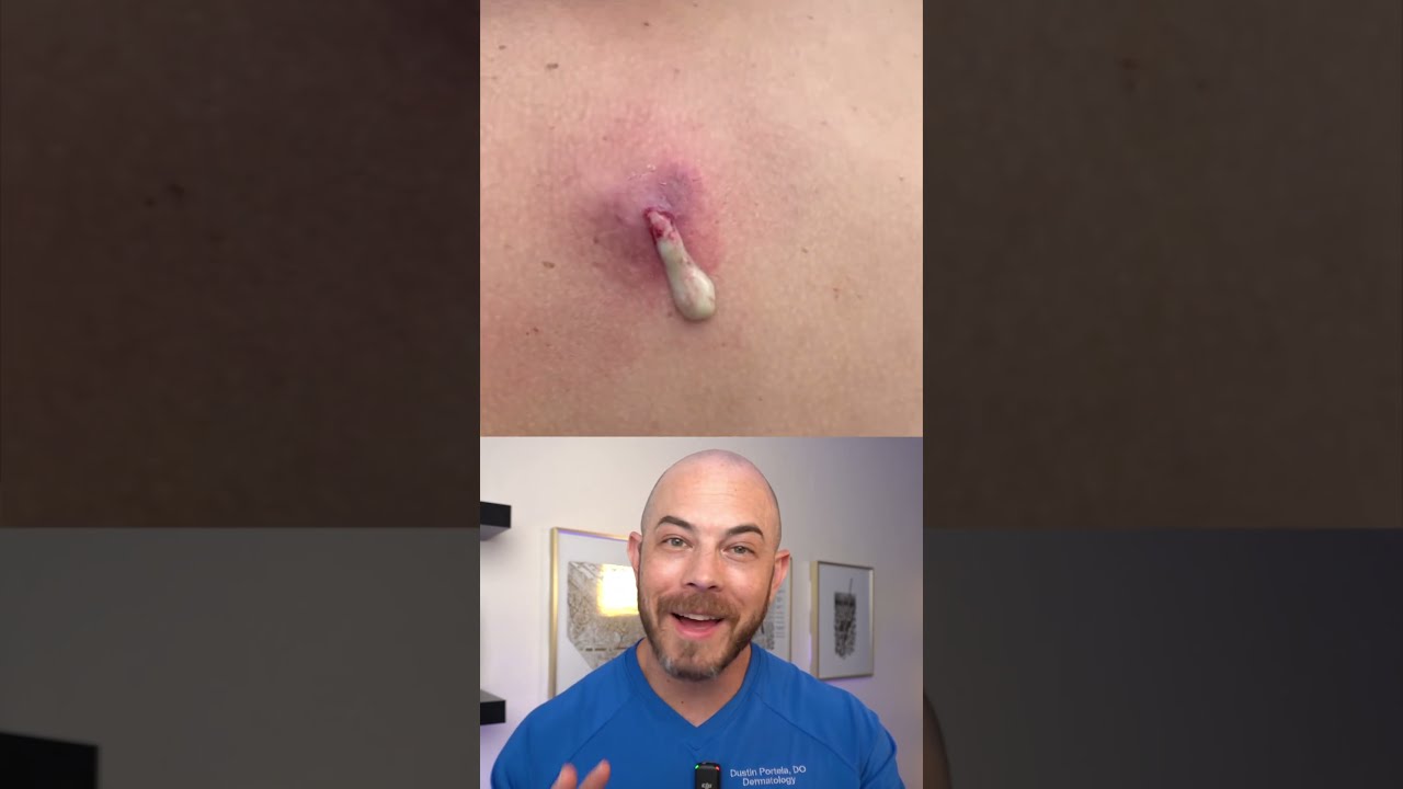 Derm Reacts To INSANELY HUGE Cyst Pop Dermreacts Doctorreacts Pimplepop Cystpop
