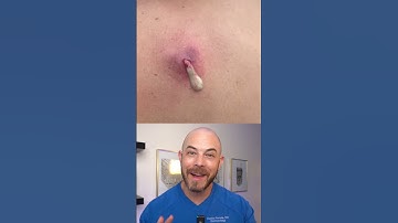 Derm reacts to INSANELY HUGE cyst pop!! #dermreacts #doctorreacts #pimplepop #cystpop