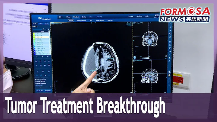 NTU Hospital contributes to first-ever AI-powered tumor auto-contouring solution - DayDayNews