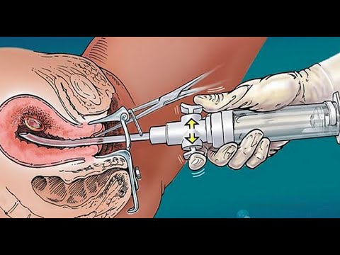 Hamiləliyin pozulması üçün nə etməli? Hansı abortu seçim? Abort növləri | ginekologiya-hamilelik.az