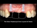 Transformando Sonrisas | Implantes Dentales en Querétaro | Dentista en Querétaro