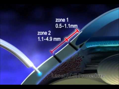 Video: Risultati Visivi 24 Mesi Dopo LaserACE