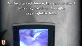 King Vision Direct Laryngoscopy Vs. Tracked King Vision