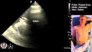 Abdominal Ultrasound of the Spleen (Basic Video)