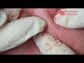 |304| Blackheads and Acne treatment in Ha Quyen Spa on 09/10/2020 part 2  & 12/10/2020