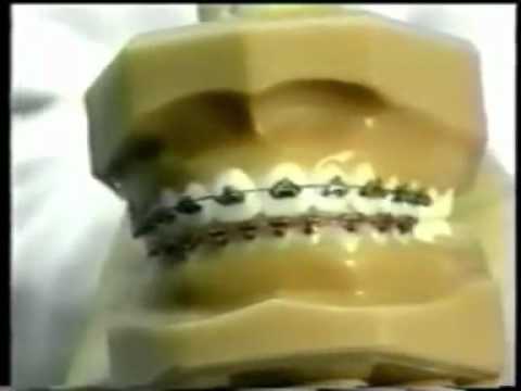 FASTBRACES® ΟΡΘΟΔΟΝΤΙΚΗ  - On Dallas NBC Station