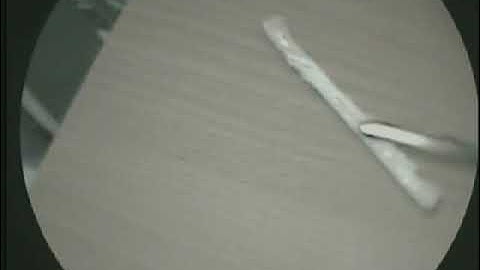 Dị vật xương gà- mắc ở Amydal bên phải