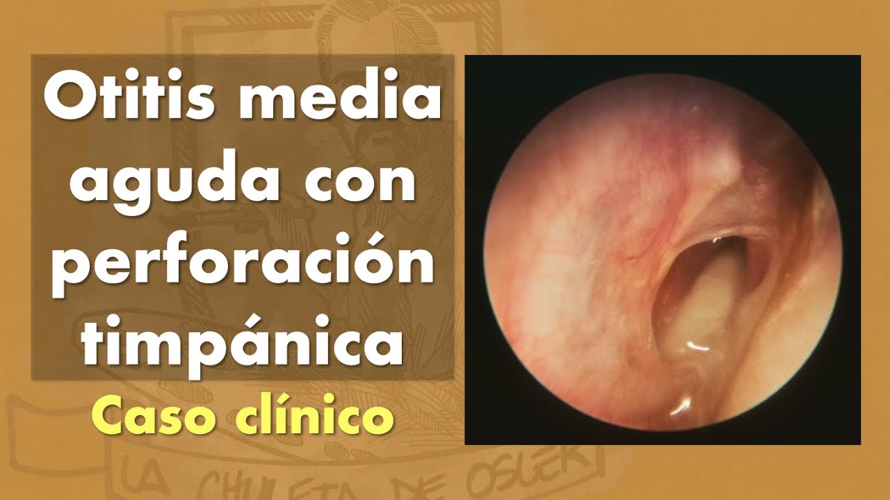 Que tomar para la otitis