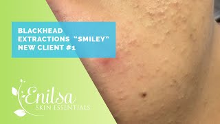 Blackhead Extractions 