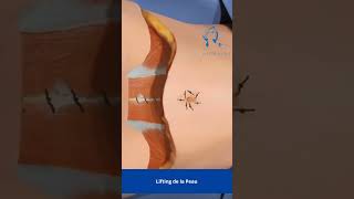 Qu'est-ce que l'Abdominoplastie ?