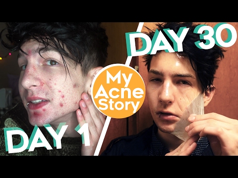 How I Cleared My Acne in  Days.