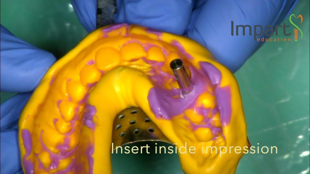 Closed tray impression technique YouTube