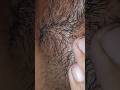 Beard therapy #hair #lifeisbutadream #ingrown #pimple #ihavethisthingwithplants #satisfying