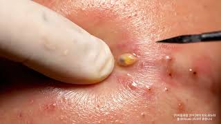 Extreme Satisfying Blackhead Removal Deep Pore Cleanse