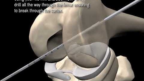 ENDOBUTTON Indicator