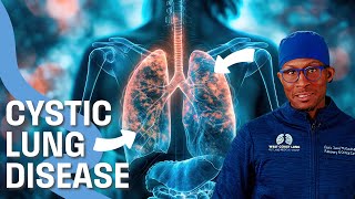 Cystic Lung Disease