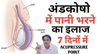 Hydrocele Ka Karan Or Ilaj। Acupressure Points For Hydrocele। Sujok Therapy For Hydrocele