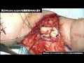 動画5-2　屈筋腱縫合：6 strand suture（Lim＆Tsai法）