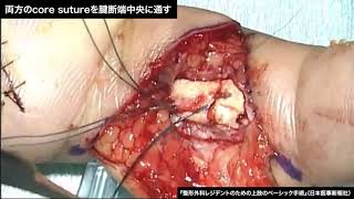 動画5-2　屈筋腱縫合：6 strand suture（Lim＆Tsai法）