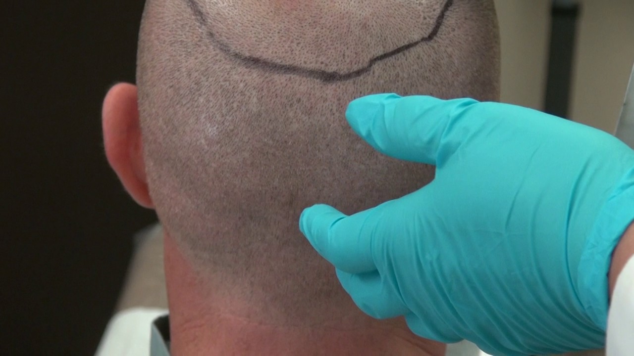 Fue Hair Transplant Donor Scar On Shaved Head By Dr Diep