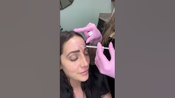 Forehead Anti-wrinkle Injections with Botox/Xeomin