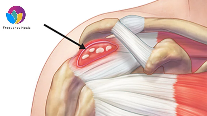 Calcification Treatment | Balance Calcium in the Body & Stop the Hardening of Soft Tissues