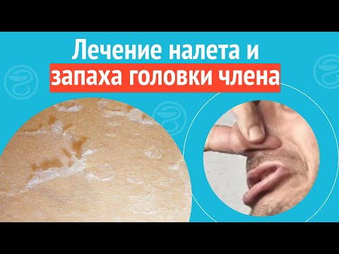 🩺 Лечение налета и запаха головки члена. Клинический случай №1127