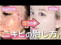 私がニキビを治した５つのこと！マスク荒れって辛すぎるよね...