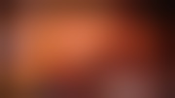 Robotic Sigmoid (for cancer) with transrectal extraction