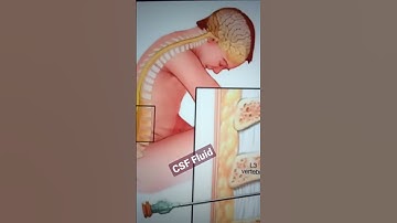 CSF Fluid Collection site #shorts