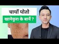 Foods to avoid in melasma  dr prakash acharya