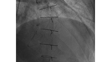 Complex Retrograde Ostial RCA CTO