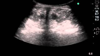 多列筋or回旋筋　筋膜リリース