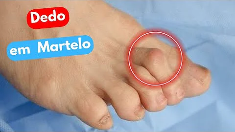 O que é um dedo martelo?