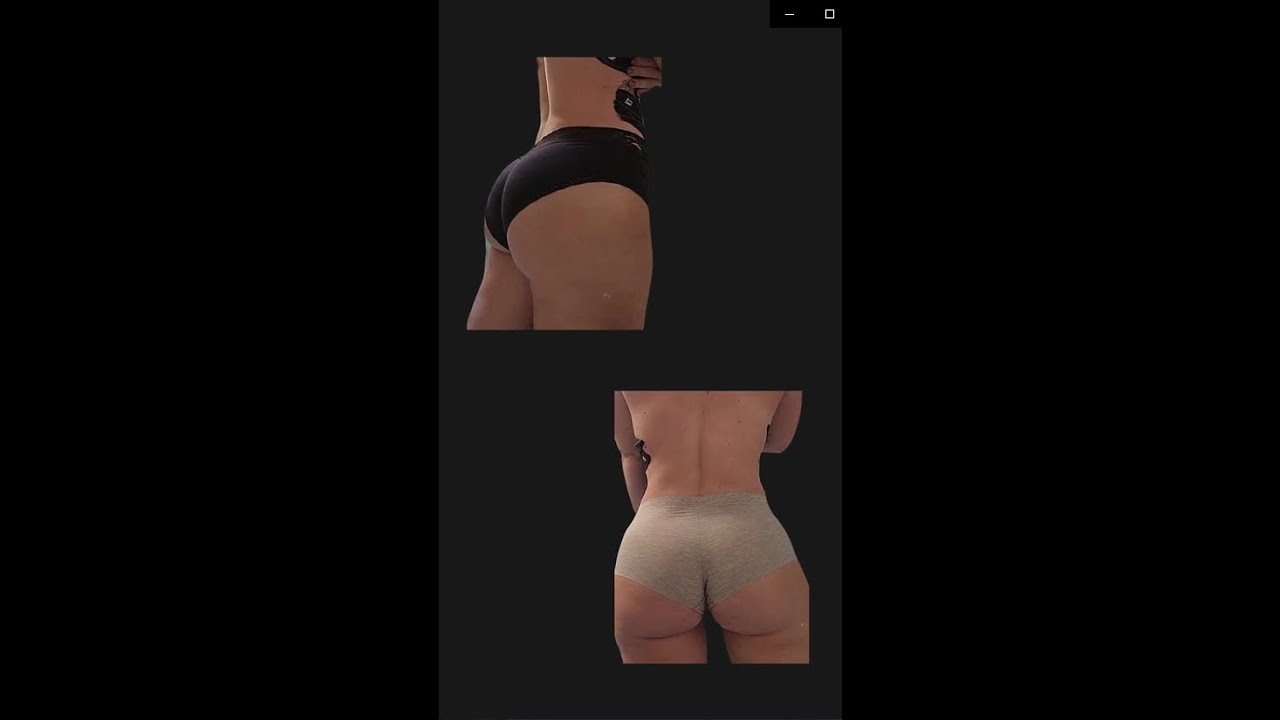 BBL by Dr. Constantino Mendieta