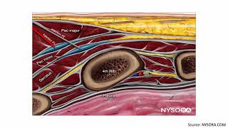 PECS I vs. PECS II Blocks by Isaac Hunter, MD Candidate Class of 2023