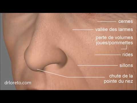 Injection d'acide hyaluronique - Tiers moyen - Docteur Federico Loreto