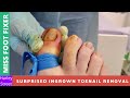 Surprised ingrown toenail removal  miss foot fixer  marion yau
