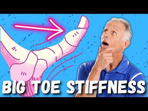 Big Toe Pain/Stiffness (Hallux Rigidus) 10 Steps to Cure.