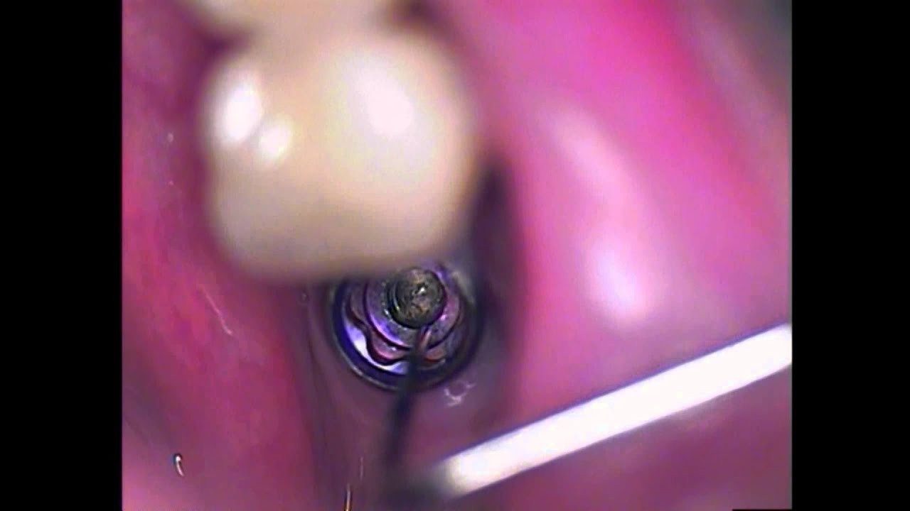 Dental Implant Broken Screw difficult retrieval using a tap/threading