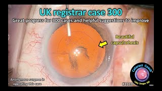 CataractCoach™ 2110: UK registrar case 300 review - give your advice