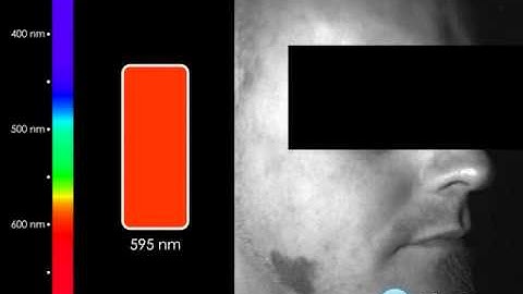 Photon etc. - Dermatological example