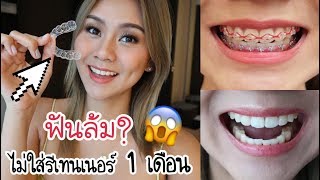 ฟันล้มไหม? ไม่ใส่รีเทนเนอร์แค่ 1 เดือน มาดูกันชัดๆ!! 😂