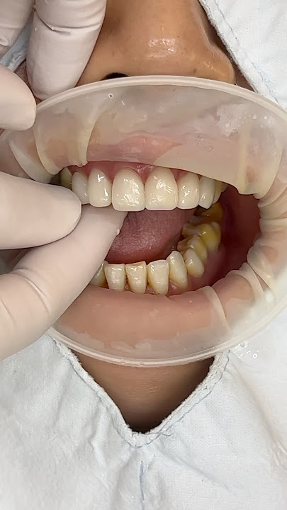 앞니재치료 rework of ant. veneers #dental #dentist #smile #veneers